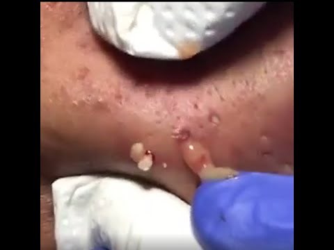 BIG Blackheads!! on hairline and eyebrow. New ASMR Pimple Popping!