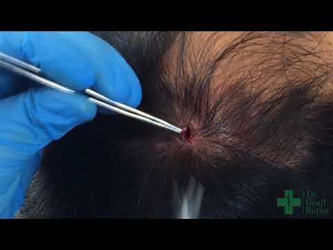 Complete Removal of an Intact Pilar Cyst