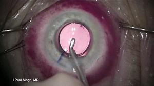 Bidirectional Toric IOL Rotation - Eyetube