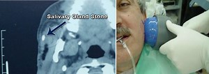 Salivary Gland Stones Treatment: Lithotripsy