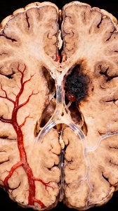 3.8M views · 35K reactions | An ischemic stroke begins the moment a...