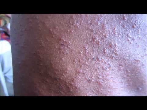 Sweat Rash (Miliaria Profunda)