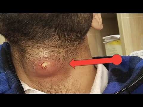 large Neck Abscess Removal