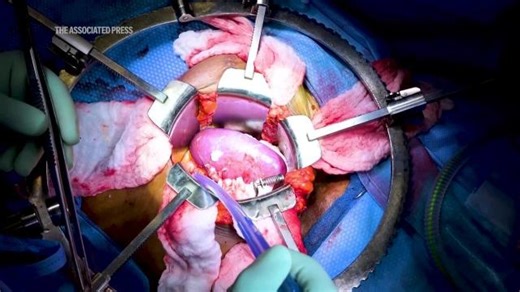 Alabama woman received a pig kidney transplant last month after eight years on dialysis