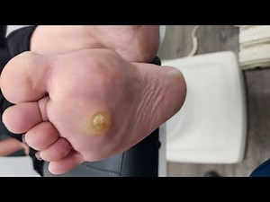 Intractible Plantar Keratosis (IPK) and Its Association with Smoking