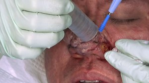 Dr. Sandra Lee uses a hot-wire loop to help "resculpt" a patient's nose who has a severe case of rhinophyma. #DrPimplePopperThisIsZit Watch full episodes on discovery : https://bit.ly/3HfHr6e | Love Science