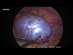 Laparoscopic ovarian cystectomy of large ovarian cyst