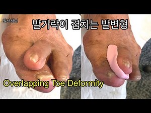 (ENG) 발가락이 겹치는 발변형 치료 Overlapping Toe Deformity Treatment