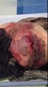 Pregnant Woman Infested With Maggots