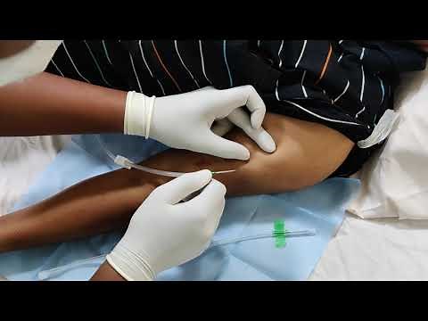 Hemodialysis Parmanent Access: AV Fistula Cannulation