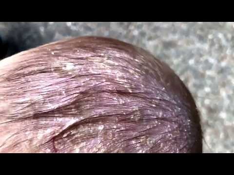 What is Cradle cap? (infantile seborrheic dermatitis)