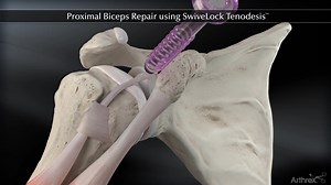 Proximal Biceps Repair using SwiveLock®  Tenodesis