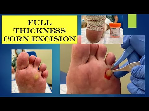 video - full thickness corn excision
