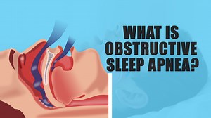 Sleep apnea, commonly known as obstructive sleep apnea, is when the...