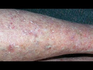 Cellulitis:- causes, symptoms, diagnosis and treatment