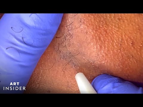 Electrolysis Permanently Removes Body Hair