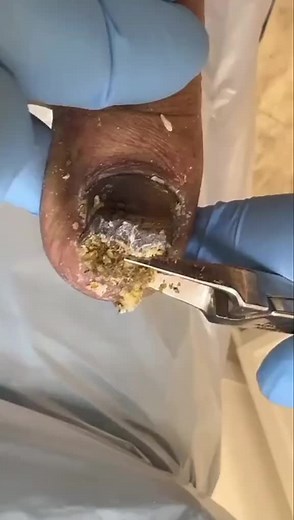 Treating a critical fungal toenail with onychomycosis 👣 #fungus #mycosis #onychomycosis #fungaltoenail #fungaltoenailtreatment #toenailtreatment #footpain #fyp #satisfying #relaxing #viralvideo @FootWorks Relaxing