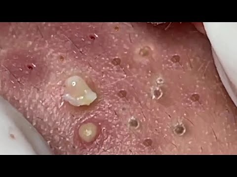 Nasa SPA #03 satisfying cyst relaxing blackhead, pimple, acne