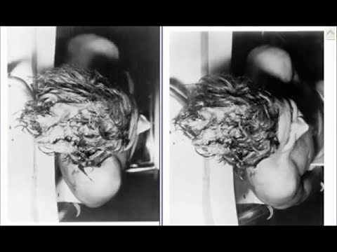 3D Photo of JFK Autopsy WARNING Graphic