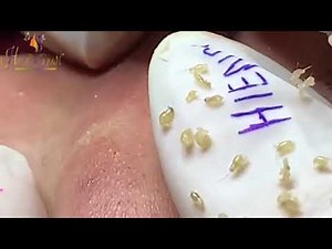 Hien Nguyen Acne #101 Relaxing Blackheads Removal