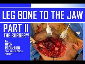 The Surgery | Leg Bone To The Jaw | Part 2 • Video • MEDtube.net