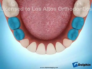 Expander on lower jaw for mixed dentition (with milk teeth and permanent teeth). #harvandental | Harvan Dental Clinic