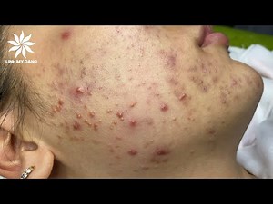 Relaxing Acne Treatment #14 | Inflamed Acnes