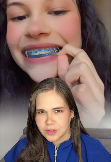 Ligas intermaxilares de brackets: para qué sirven y cómo funcionan