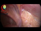 Proper Positioning of the Patient is Essential in Laparoscopic Surgery • Video • MEDtube.net