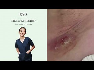 Armpit with shooting pus