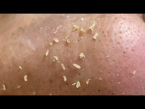 Nose Perfection: Extreme Blackhead Extractions