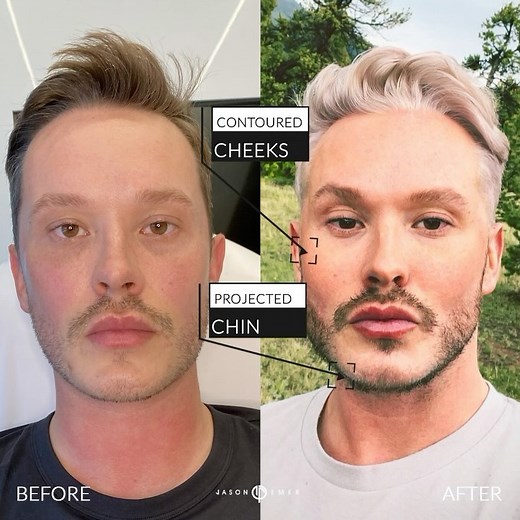 MALE FACIAL SCULPTING Our patient is a model and wants to look...