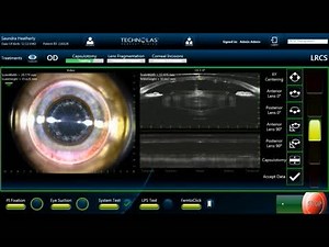 Femtosecond Laser Cataract Surgery Using the Storz Zero Phaco IA Hand Piece - Eyetube