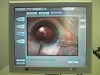 Toric IOL Alignment With the Callisto Z Align - Eyetube