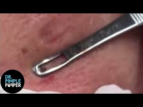 Creamiest Blackhead! Dr Pimple Popper Pops MASSIVE Blackhead