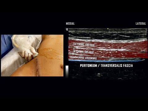 Transversus Abdominis Plane (TAP) Block // Ultrasound-Guided Demonstration