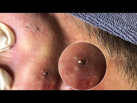 AWESOME COMEDONES BEHIND EARS | Suri Job 110