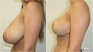 Breast Reduction using the Vertical Technique explained by Dr Michael Miroshnik, Plastic Surgeon