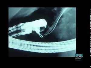 Retrieval of Proximally Migrated Pancreatic Stents