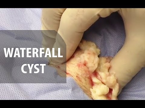 Waterfall Cyst | Dr. Derm