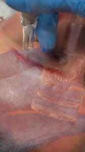 Phiremoval ia the only removal technique that can remove any colour if the client is patient enough. I cannot wait to show you the healed result of these soon. #phiremoval #phibrows #tattooeemovals #teamlaurac #phiacademy #removetattoo | PhiBrows London - Master Laura C