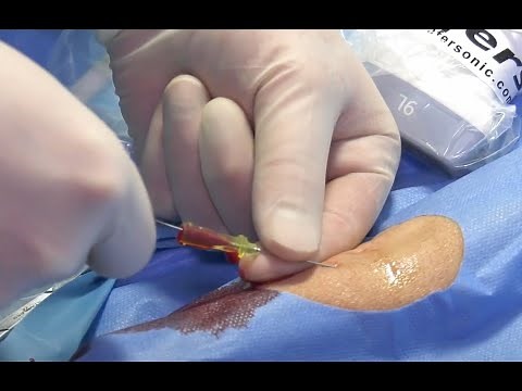Radial artery line insertion