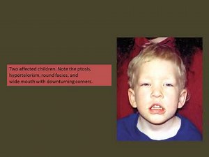 DELETION 18P SYNDROME 18P SYNDROME)