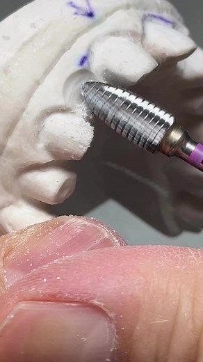 4.4K views · 32 reactions | Temporary for Ovate Pontics! HORICO | Luke Kahng | Facebook