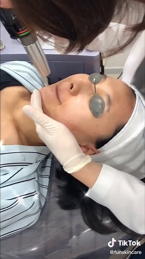 Nd:YAG Laser for Acne Scars Treatment