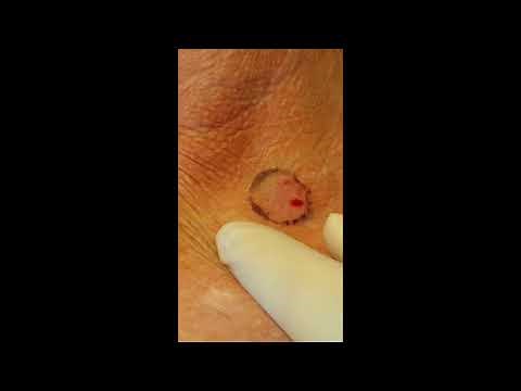 Punch biopsy technique. #6