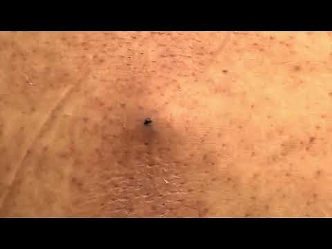 Satisfying Back Acne Extraction | Deep Cleansing Session