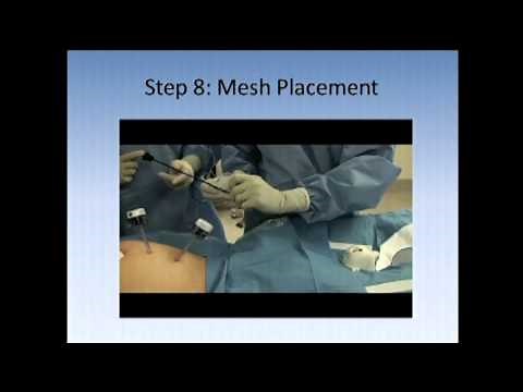 SAGES Pearls Session: Laparoscopic Inguinal Hernia Repair Introduction - Technique Video