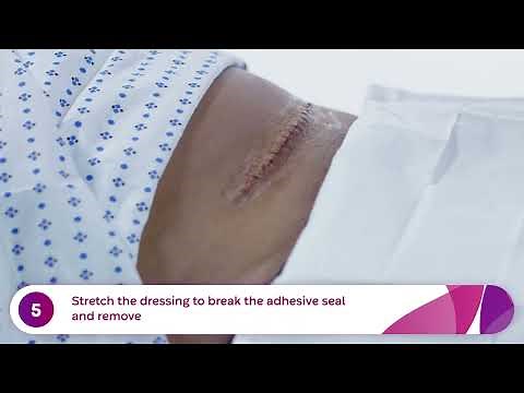How to Apply and Remove Aquacel® Ag Surgical Dressings (C-Section)