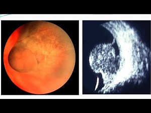 Retinal Detachment | Opthalmology